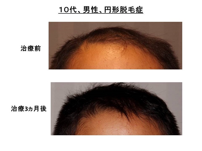 円形脱毛症　病院